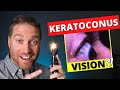 What Is Vision Like With Keratoconus And Irregular Astigmatism?