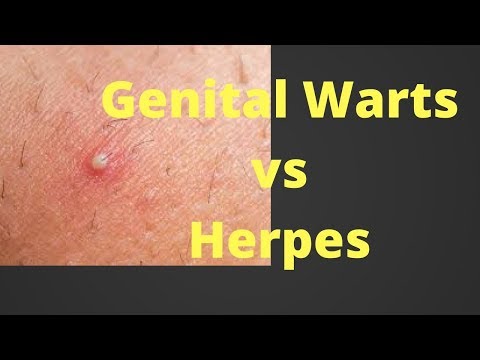 Hpv vs herpes warts