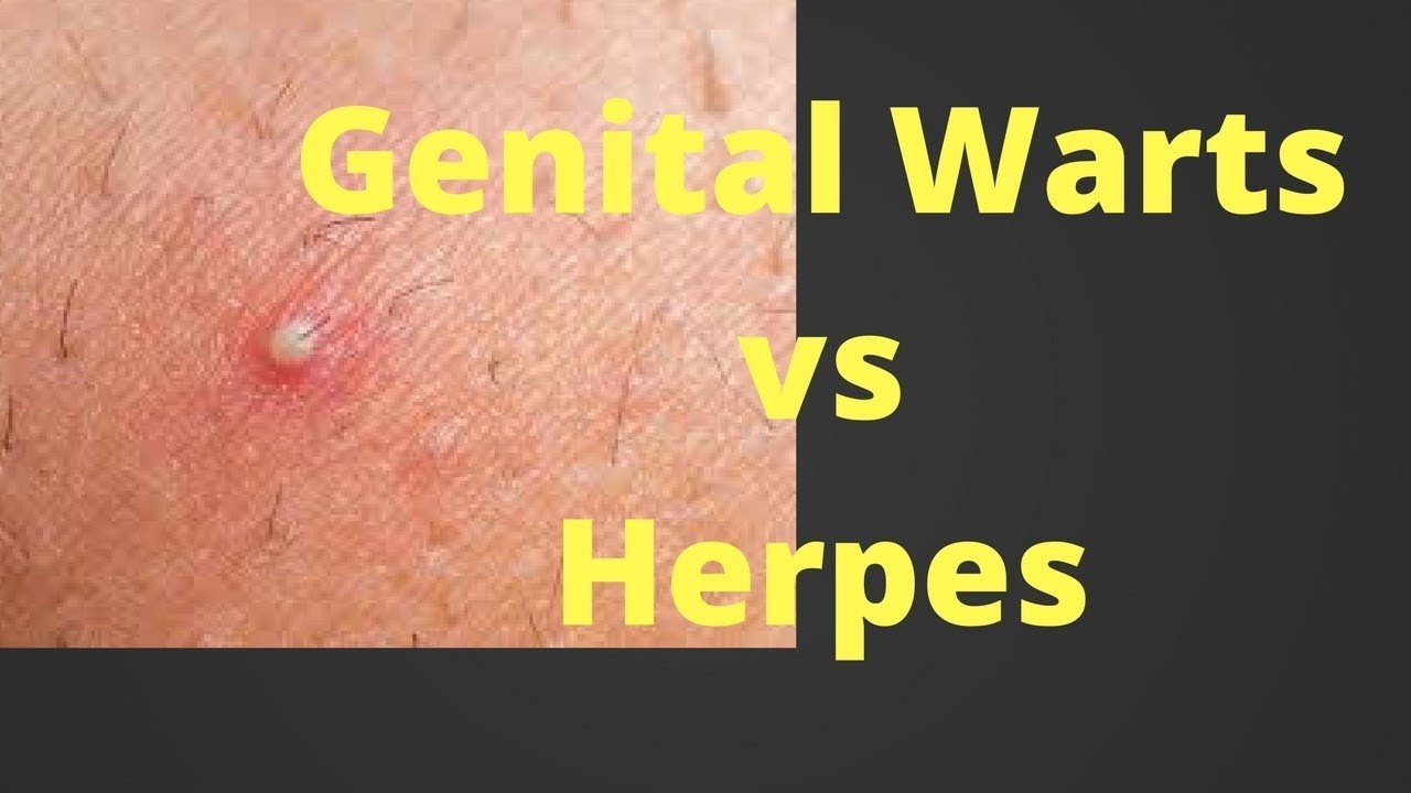 HPV vs. herpes: what's the difference?