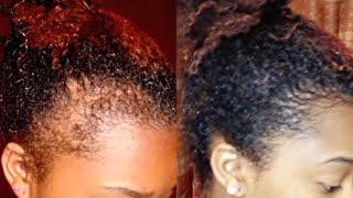 How to Regrow your Edges, Bald Spots, and Thinning Hair!
