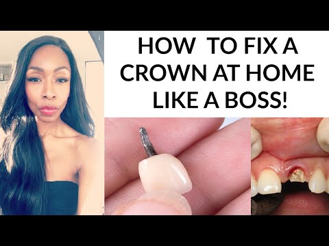 HOW TO FIX A CROWN OR BRIDGE AT HOME LIKE A BOSS!