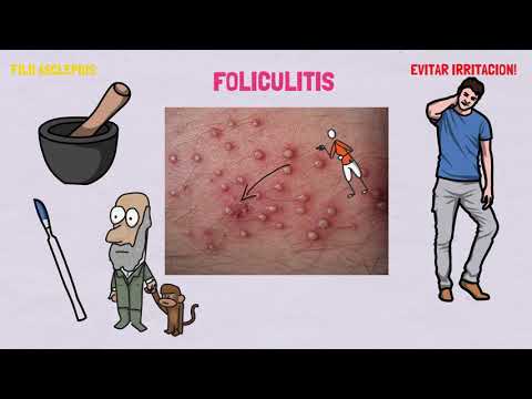 TRATAMIENTO PARA LA FOLICULITIS