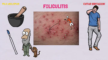 ¿Se puede poner vinagre en la foliculitis?