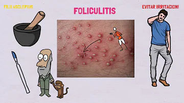 ¿Es normal la foliculitis?