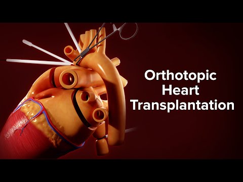 मेडिकल एनिमेशन: ऑर्थोटोपिक हार्ट ट्रांसप्लांटेशन | सिनसिनाटी चिल्ड्रन