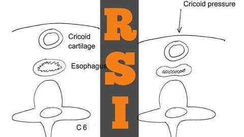 RAPID SEQUENCE INDUCTION PART 1