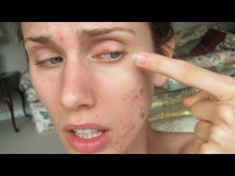 Pimples on my eye!? is it a stye!? talkin tuesday! kinda... youtube Stue skab