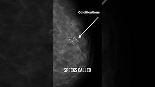 Dcis Stage 0 Breast Cancer