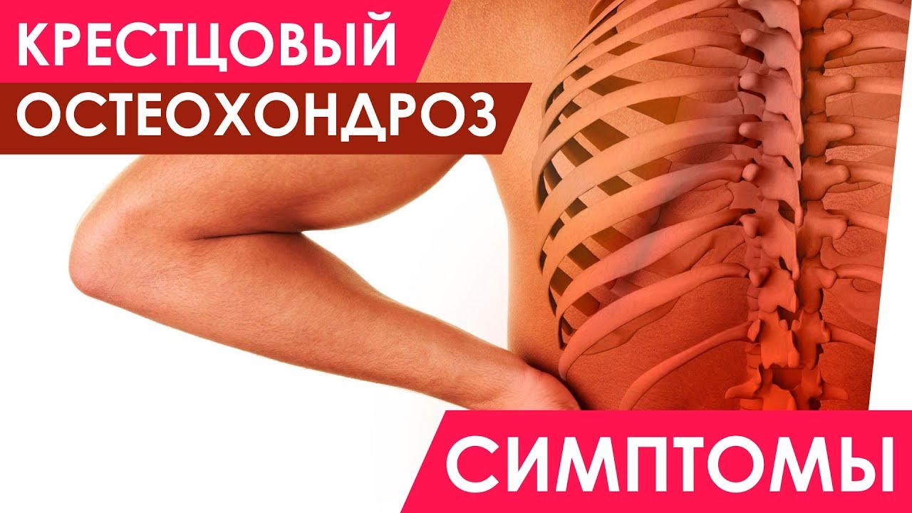 Крестцовый остеохондроз симптомы