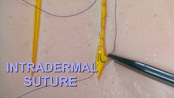 7.  Surgical Sutures. Intradermal Suture.