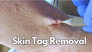 Skin Tag Surgically Removed! | CONTOUR DERMATOLOGY