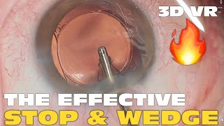3D Phaco Clip #168 - Traumatic Cataract 