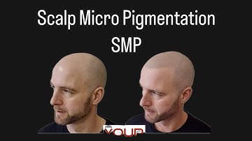 Hoofdhuidmicropigmentatie tegen haaruitval heeft mijn leven veranderd (en me er jonger uit laten ...