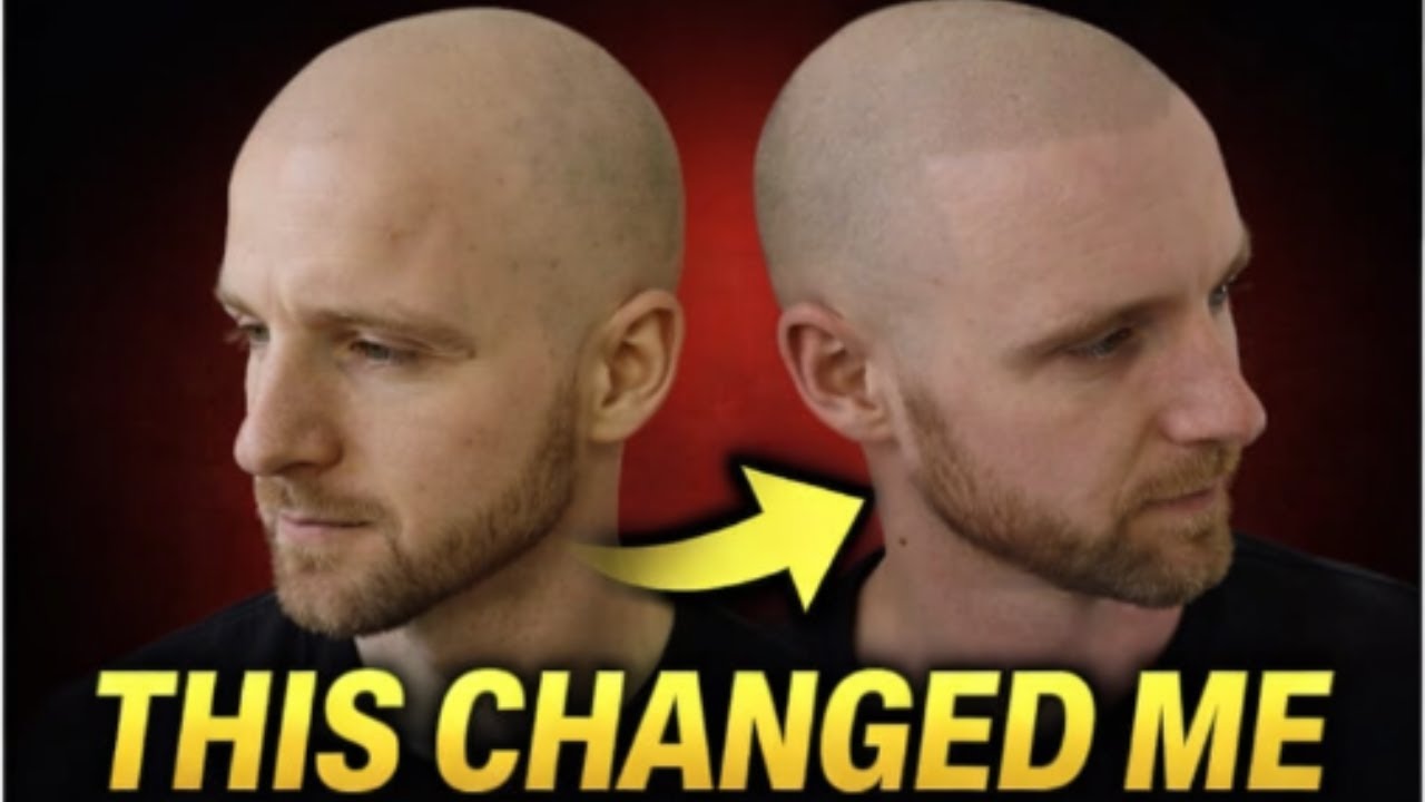 Микропигментация кожи головы (SMP) для лечения выпадения волос изменила мою жизнь (и сделала меня...