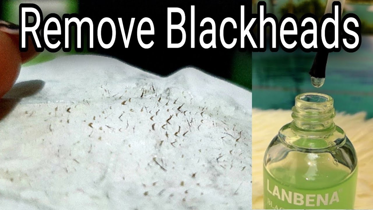 Remove Blackheads and Whiteheads in 3 Minutes, (100 Result) Best