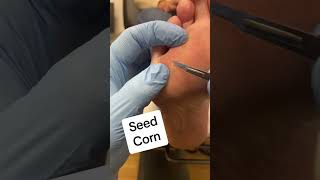 Painful seed corn and callus removed by a podiatrist with a scapel #corn #callus #podiatrist #satisf