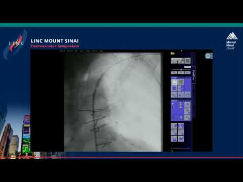 Video: Subclavian Arterie - Struktur, Stenose, Behandling