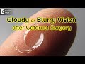 How long is your vision blurry or cloudy after cataract surgery? - Dr. Sriram Ramalingam