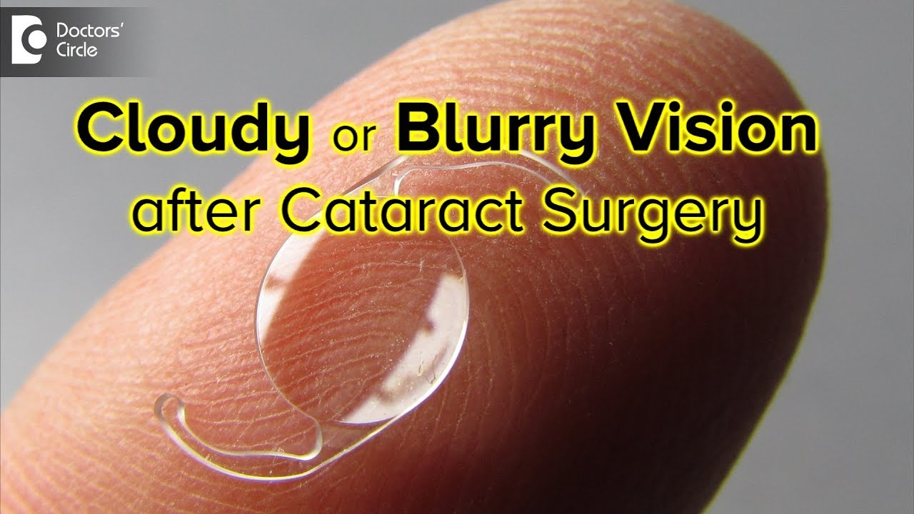 How Long Is Your Vision Blurry Or Cloudy After Cataract Surgery? - Dr. Sriram Ramalingam