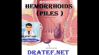 Lecture Notes On Hemorrhoids / Piles / Hemorrhoid Surgery / What are hemorrhoids  / Medical lecture