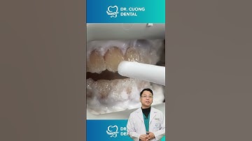 Tẩy trắng răng thì có trắng răng không? | Bác sĩ Cường