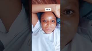 Acne, Pimples and hyperpigmentation gone. we speak results ❤️. ? 08066416703.