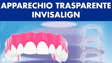 APPARECHIO trasparente con allineatori dentali invisibile - INVISALIGN ©