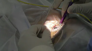 Come si cura il glaucoma oculare?
