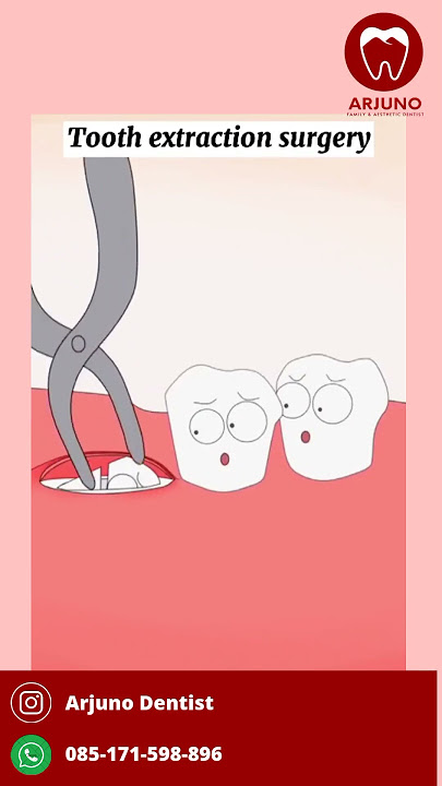 Berikut ilustrasi pencabutan gigi yang terimpaksi                          Cr : mocoo