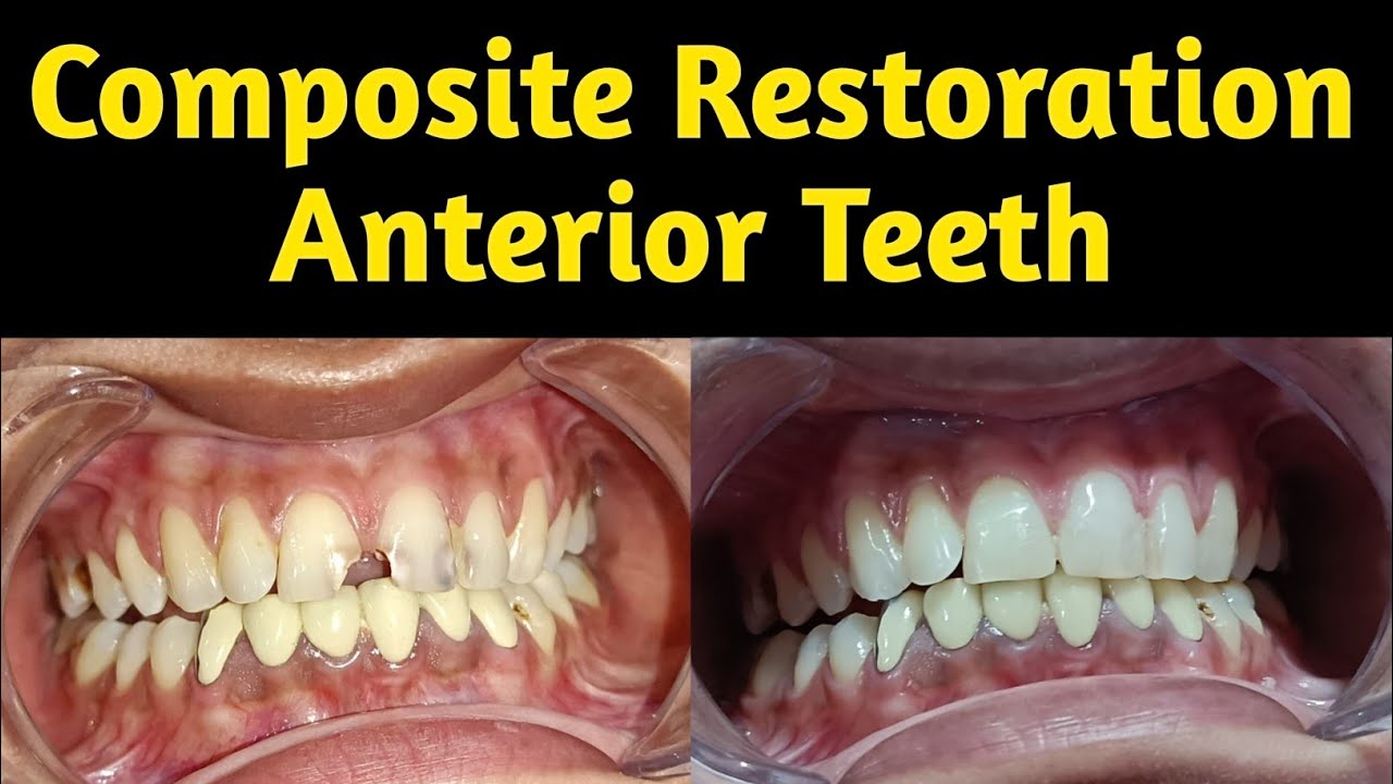 Composite Restoration Anterior Teeth 👍 by Dr. Shivam Verma 💯🔥 - YouTube