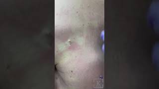 BACK EXTRACTIONS (AGAIN) - KAADO MD