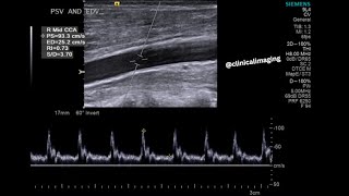 Pulse Wave Doppler - In 2 Minutes