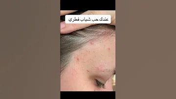حبوب وجه سببها فطري انتبهوا 