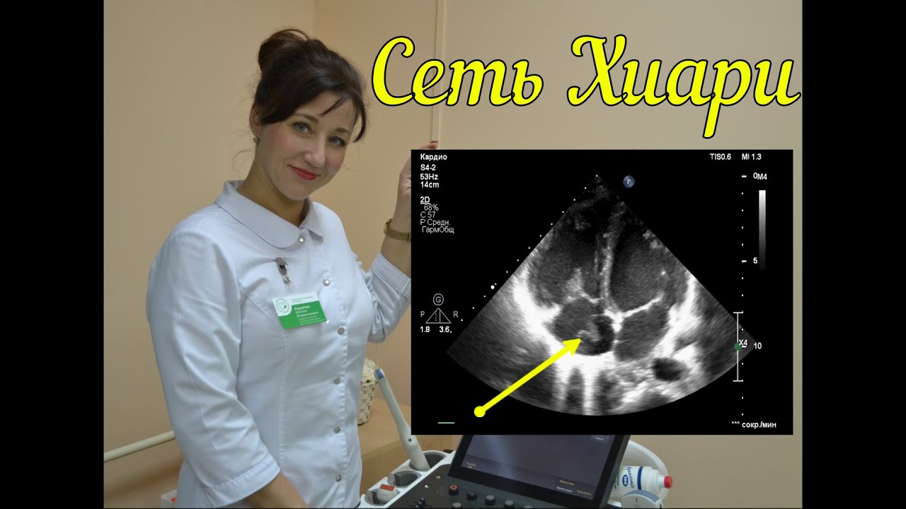 сеть хиари на узи. евстахиев клапан на эхокг. сеть киари в правом предсердии. евстахиев клапан на эхокг. сеть хиари в правом предсердии.