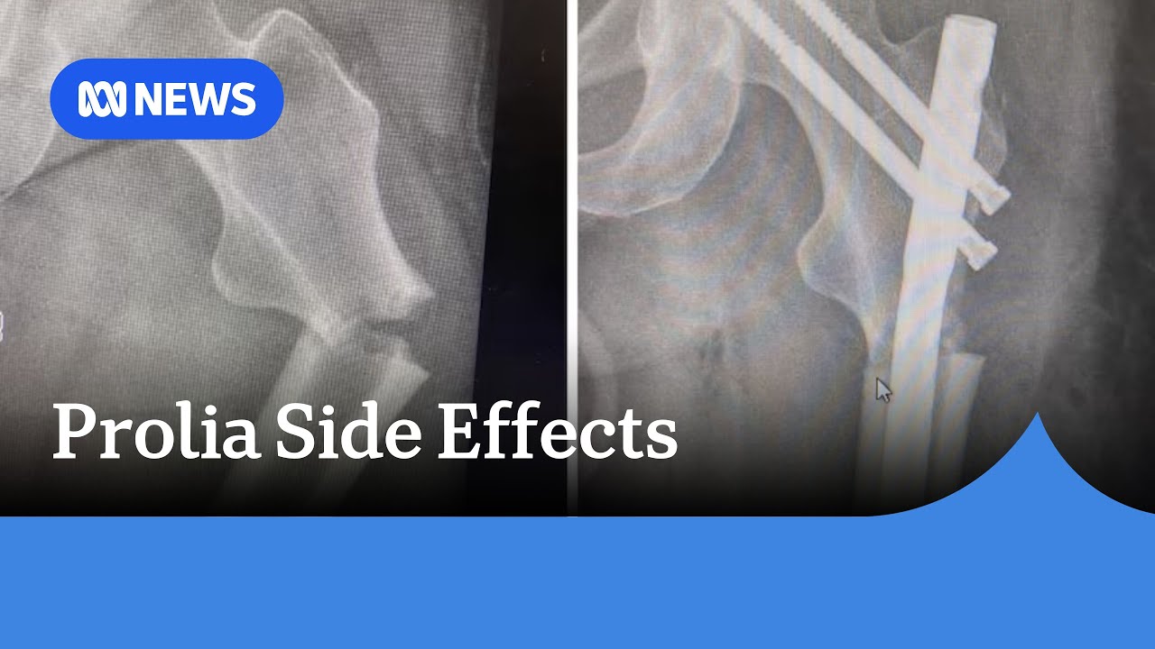 Patients not being warned about the side effects of osteoporosis drug Prolia | ABC News