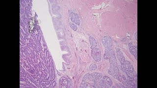 Urachal Tumours - Pathology mini tutorial