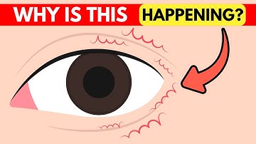 What is Eyelid Twitching? Simply Explained
