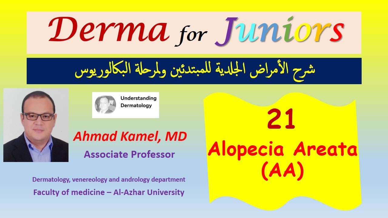 021 Alopecia areata AA