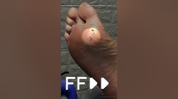 Wart Removal with Topical Medication #shorts