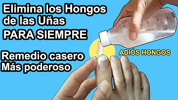 ¿Cómo puedo deshacerme de la sustancia blanca que tengo debajo de las uñas de los pies?