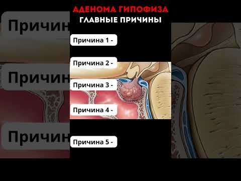 КАК СПАСТИ МОЗГ ОТ АДЕНОМЫ ГИПОФИЗА? #меднавигатор #аденома #мозг