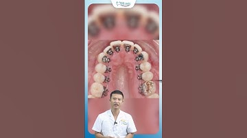 Niềng Răng Mặt Lưỡi Có Đau Không ?| Bác Sĩ Yên