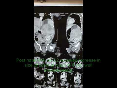 Video: Lasten Neuroblastoma - Muodot, Vaiheet, Oireet, Diagnoosi, Hoito