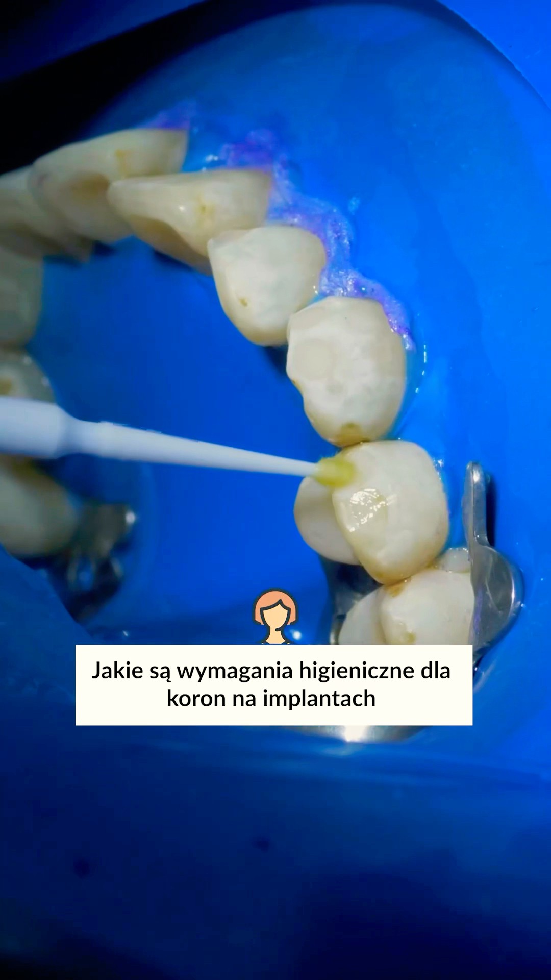 Jakie są wymagania dla koron na implantach?