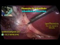 Lap cholecystectomy  gallstone stuck on infundibulum  full.gopro