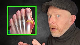 IMPORTANT UPDATE: Does The Carnivore Diet Cause Gout?