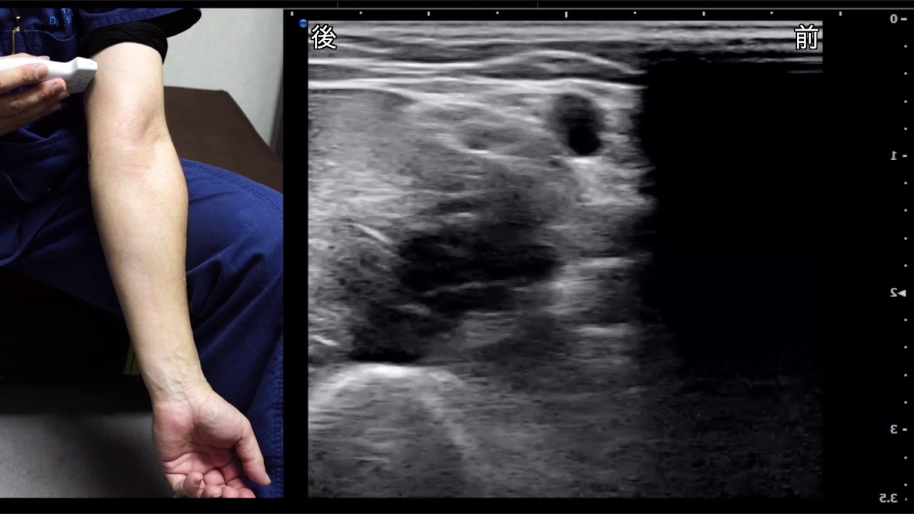 （まとめ）前腕静脈穿刺で障害される末梢神経