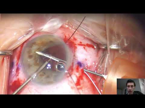 Repositioning of a Dislocated IOL-CTR-Capsular Bag Complex - Pre- and Post-Operative Video