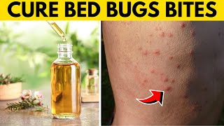 how to get rid of bed bug bites overnight while sleeping - Best treatment for bed bug bites