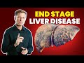 10 Signs of a Dying Liver  (End Stage Liver Disease)